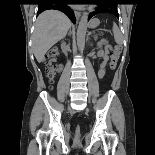 File:Colocutaneous fistula in Crohn's disease (Radiopaedia 29586-30093 Coronal non-contrast 23).jpg