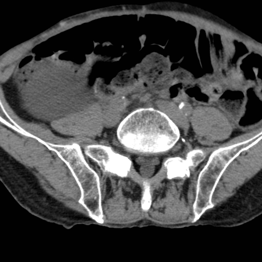 Colon cancer with calcified liver metastasis (Radiopaedia 74423-85309 Axial non-contrast 77).jpg