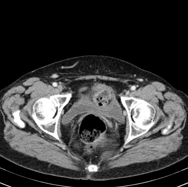 Colon carcinoma with hepatic metastases (Radiopaedia 29477-29961 A 108).jpg