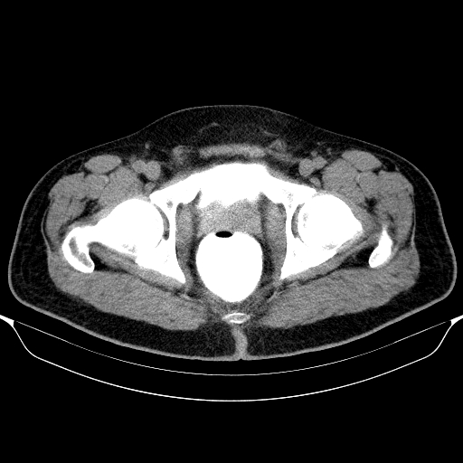Colonic lipoma with colo-colic intussusception (Radiopaedia 58944-66200 Axial C+ rectal 72).jpg