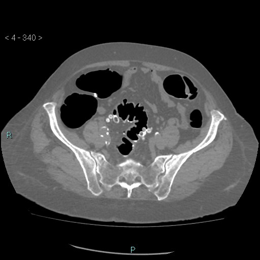 Colonic lipomas (Radiopaedia 49137-54244 Axial bone window 152).jpg