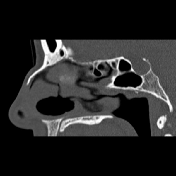 Nasal septal perforation (Radiopaedia 25030-25289 Sagittal bone window 26).jpg