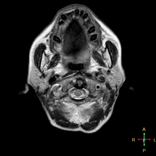 File:Nasopharyngeal carcinoma infiltrating the clivus (Radiopaedia 25229-25481 Axial T2 1).jpg