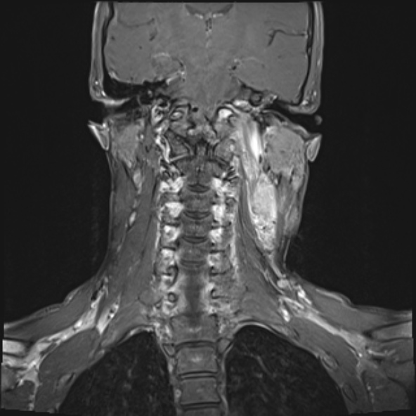 Nasopharyngeal carcinoma with skull base invasion (Radiopaedia 53415-59485 E 12).jpg