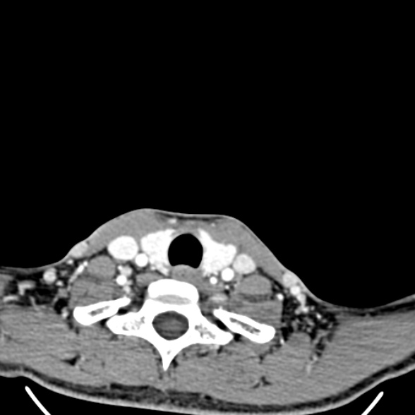 Nasopharyngeal carcinoma with skull base invasion (Radiopaedia 53415-59705 A 178).jpg