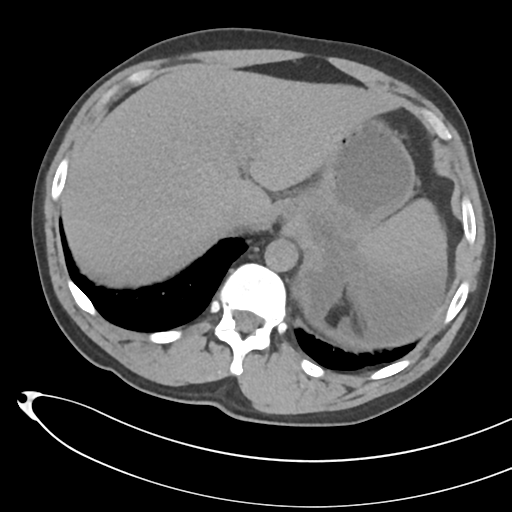 File:Necrotizing pancreatitis with acute necrotic collections (Radiopaedia 38829-41012 Axial non-contrast 17).png