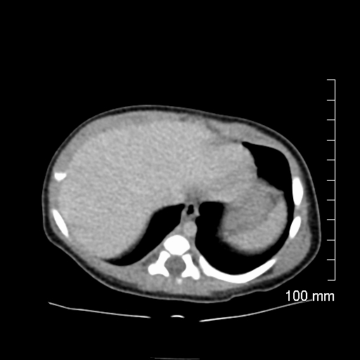 File:Neonatal neuroblastoma (Radiopaedia 56651-63438 Axial non-contrast 15).jpg