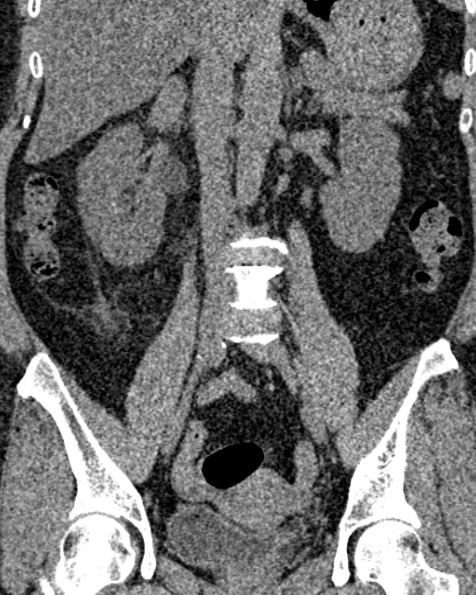File:Nephrostomy for urosepsis (Radiopaedia 26180-26330 non-contrast 50).jpg