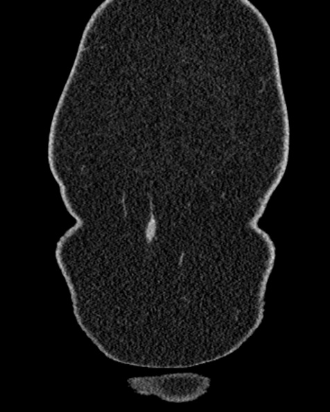 File:Nephrostomy for urosepsis (Radiopaedia 26180-26330 non-contrast 6).jpg