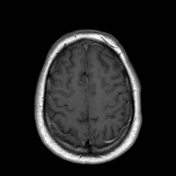 File:Neuro-Behcet's disease (Radiopaedia 21557-21505 Axial T1 C+ 18).jpg