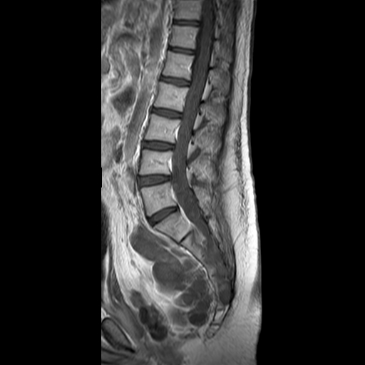 File:Neurofibromatosis type 1- extensive spinal involvement and Christmas tree sign (Radiopaedia 60610-68332 Sagittal T1 C+ 8).jpg