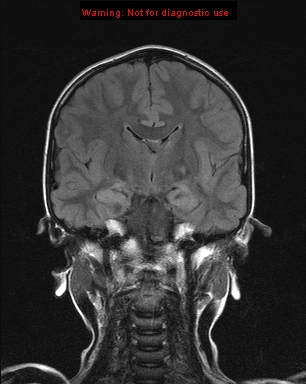 File:Neurofibromatosis type 1 with optic nerve glioma (Radiopaedia 16288-15965 Coronal FLAIR 13).jpg