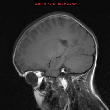 File:Neurofibromatosis type 1 with optic nerve glioma (Radiopaedia 16288-15965 Sagittal T1 16).jpg