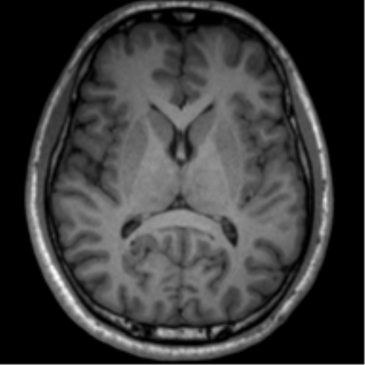 File:Neurofibromatosis type 2 (Radiopaedia 44936-48838 Axial T1 78).png