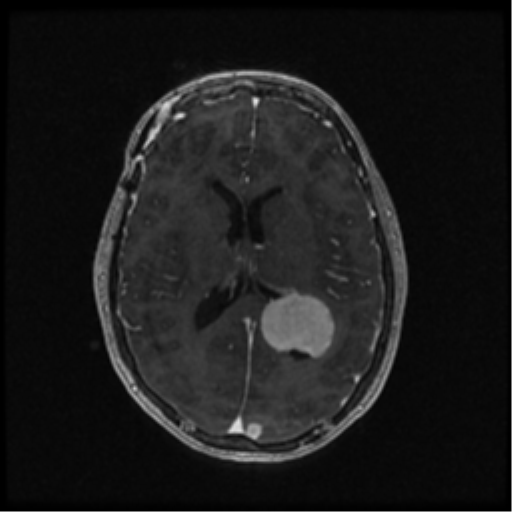 Neurofibromatosis type 2 (Radiopaedia 45229-49244 Axial T1 C+ 71).png
