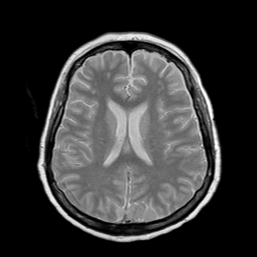 File:Neurofibromatosis type 2 (Radiopaedia 8713-9518 Axial Gradient Echo 10).jpg