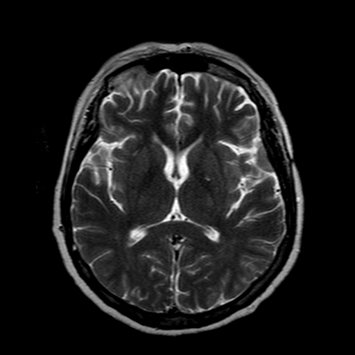 File:Neurofibromatosis type 2 (Radiopaedia 8713-9518 Axial T2 12).jpg