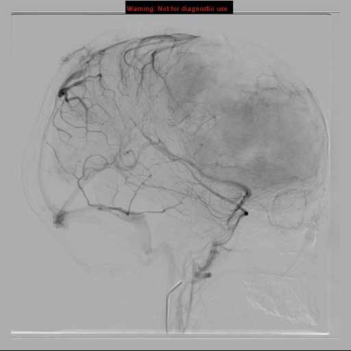 File:Neurofibromatosis type 2 (Radiopaedia 8953-9733 C 17).jpg