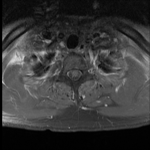 File:Neurofibromatosis type 2 (spinal manifestations) (Radiopaedia 53943-60070 J 38).png