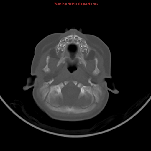 File:Non-accidental injury - bilateral subdural with acute blood (Radiopaedia 10236-10765 Axial bone window 3).jpg