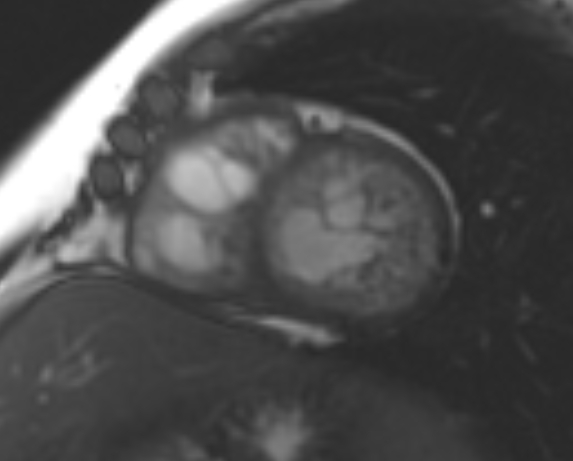 File:Non-compaction of the left ventricle (Radiopaedia 69436-79314 Short axis cine 102).jpg