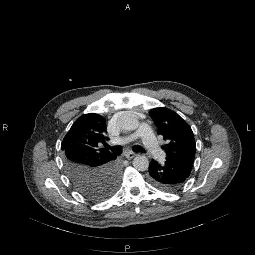 File:Non Hodgkin lymphoma in a patient with ankylosing spondylitis (Radiopaedia 84323-99624 B 12).jpg