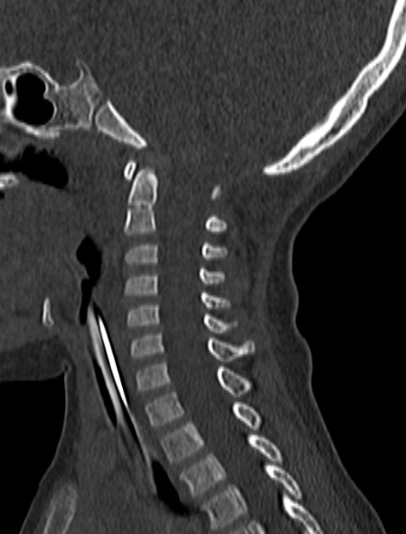 Normal CT cervical spine - pediatric (Radiopaedia 52549-58462 Sagittal bone window 113).jpg