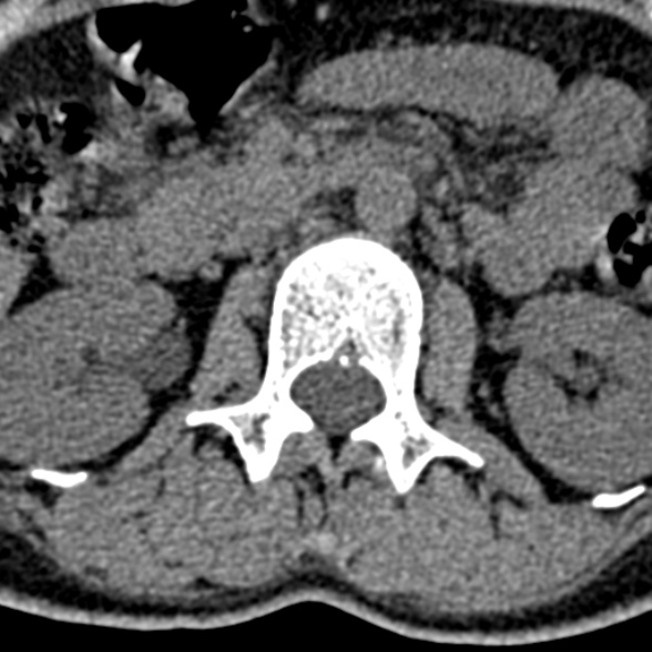 Normal CT lumbar spine (Radiopaedia 53981-60118 Axial non-contrast 31).jpg