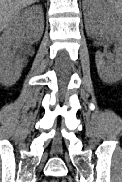 Normal CT lumbar spine (Radiopaedia 53981-60118 F 55).jpg