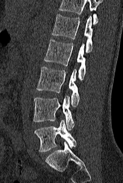 File:Normal CT lumbar spine (Radiopaedia 53981-60118 Sagittal bone window 60).jpg