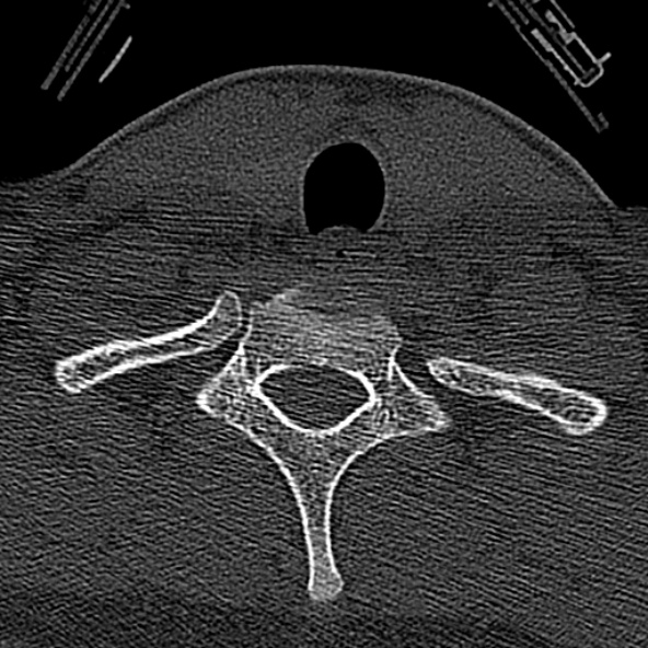 Normal CT of the cervical spine (Radiopaedia 53322-59305 Axial bone window 229).jpg