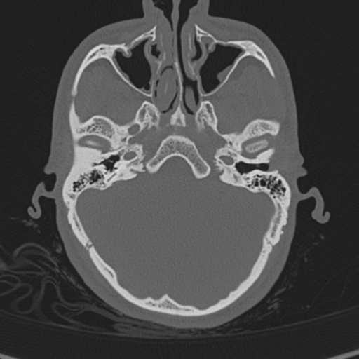 Normal CT skull (Radiopaedia 40798-43459 A 36).png