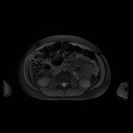 File:Normal MRI abdomen in pregnancy (Radiopaedia 88001-104541 D 27).jpg
