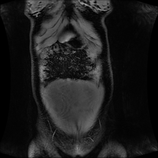 Normal MRI abdomen in pregnancy (Radiopaedia 88001-104541 M 33).jpg