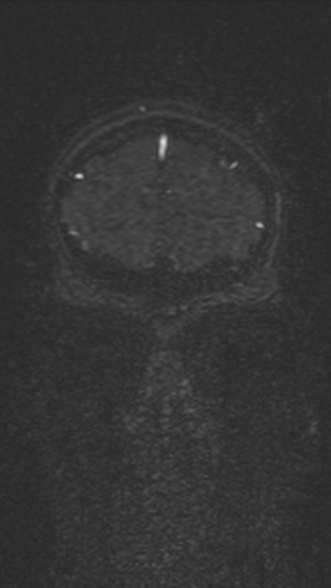 Normal MRI brain with MRV- teenager (Radiopaedia 49425-54553 Coronal MRV 46).jpg