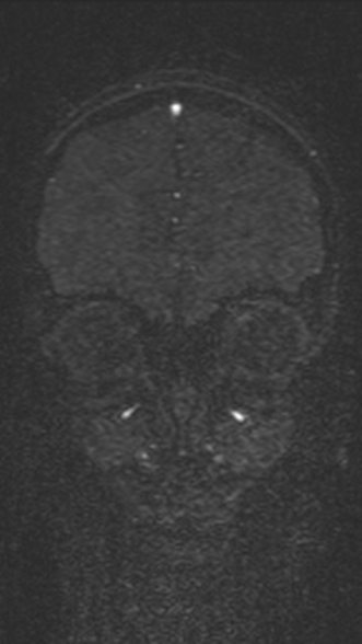 Normal MRI brain with MRV- teenager (Radiopaedia 49425-54553 Coronal MRV 63).jpg
