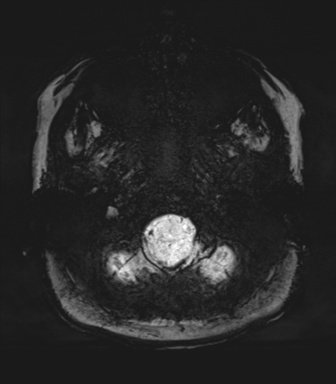 Normal MRI internal auditory canal (Radiopaedia 41613-44525 Axial SWI MIP 6).png