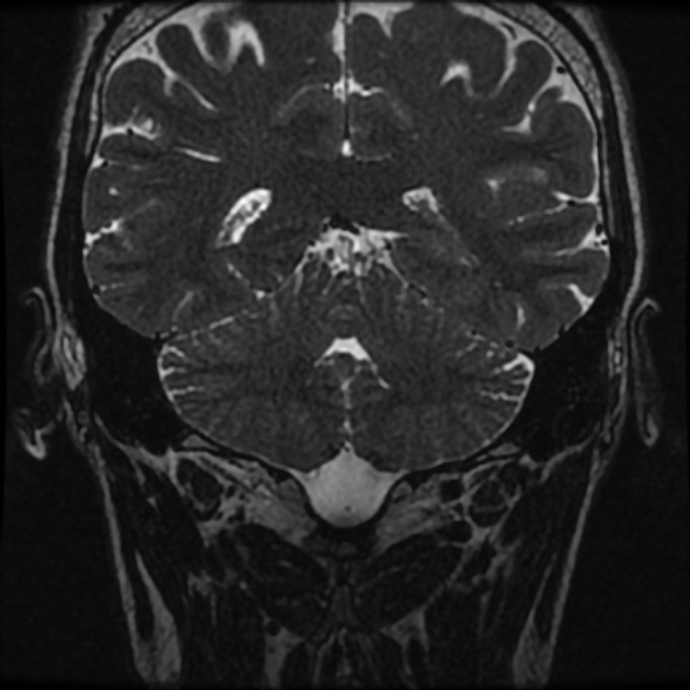 Normal MRI petrous (Radiopaedia 91317-108949 Coronal T2 91).jpg