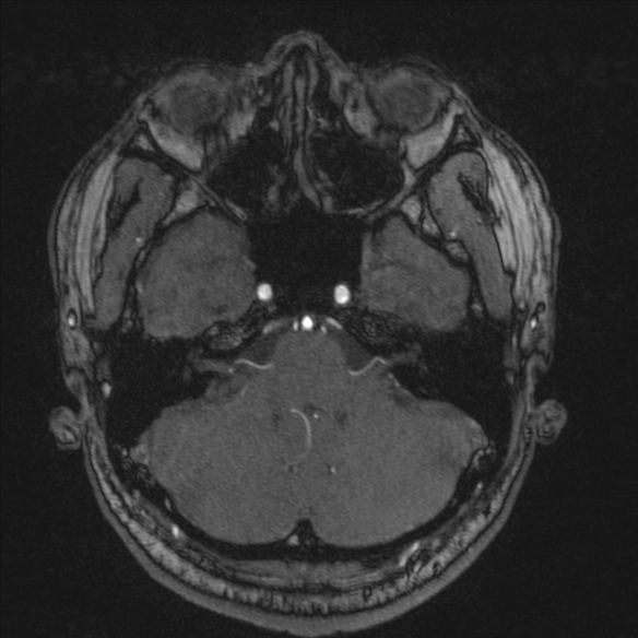 Normal brain MRI including MRA (Radiopaedia 48748-53763 Axial MRA 42).jpg