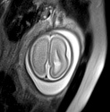 File:Normal brain fetal MRI - 22 weeks (Radiopaedia 50623-56050 Axial T2 Haste 3).jpg