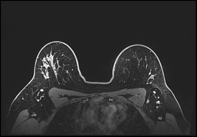 Normal breast MRI - dense breasts (Radiopaedia 80454-93850 C 168).jpg