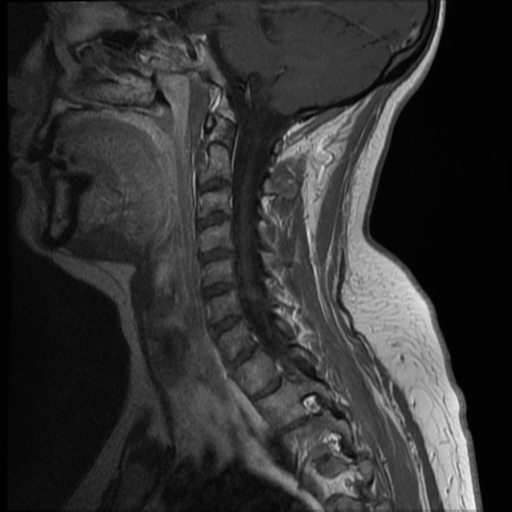 File:Normal cervical and thoracic spine MRI (Radiopaedia 35630-37156 Sagittal T1 C+ 4).png