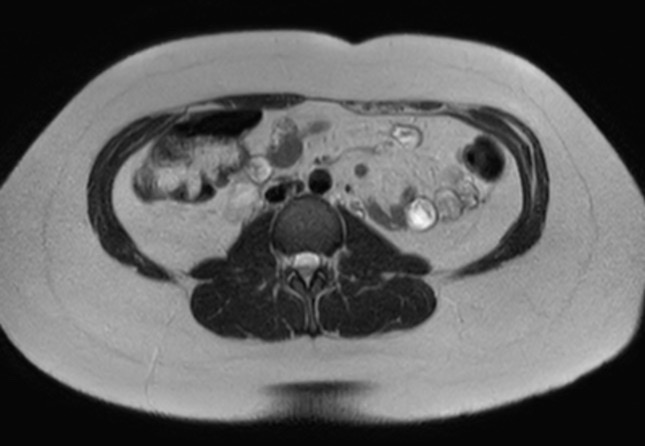 File:Normal liver MRI with Gadolinium (Radiopaedia 58913-66163 Axial T2 4).jpg