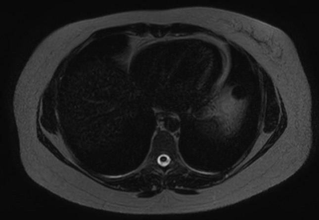 File:Normal liver MRI with Gadolinium (Radiopaedia 58913-66163 E 30).jpg