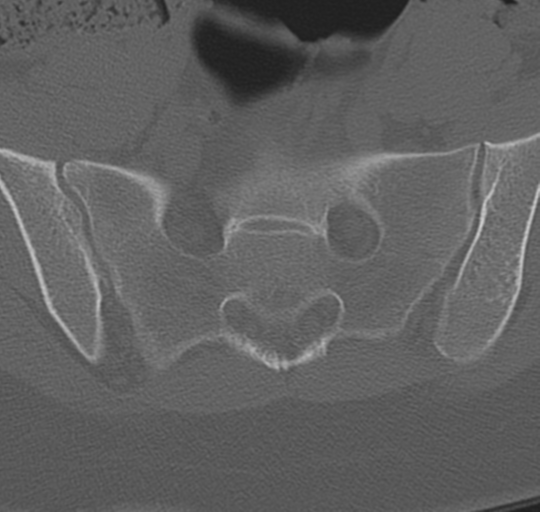 File:Normal lumbosacral CT (Radiopaedia 37923-39867 Axial bone window 88).png