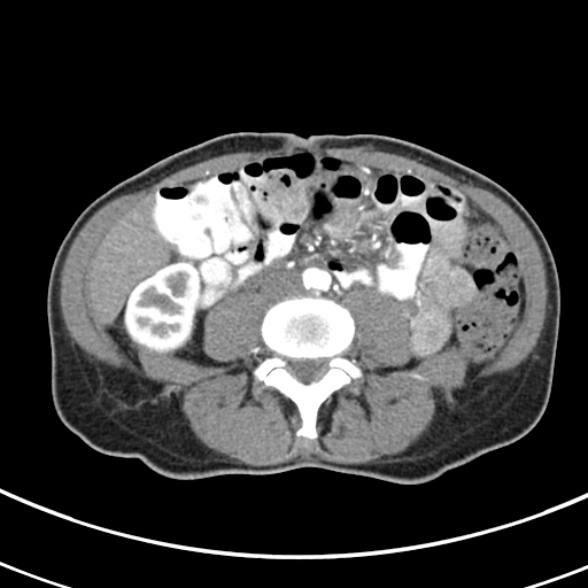 File:Normal multiphase CT liver (Radiopaedia 38026-39996 B 52).jpg