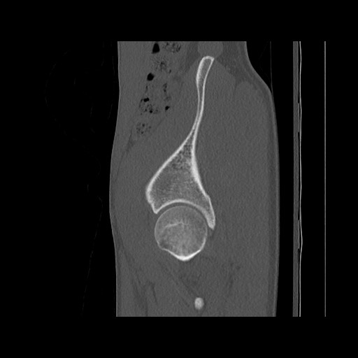 Normal pelvis (Radiopaedia 51473-57238 Sagittal bone window 32).jpg