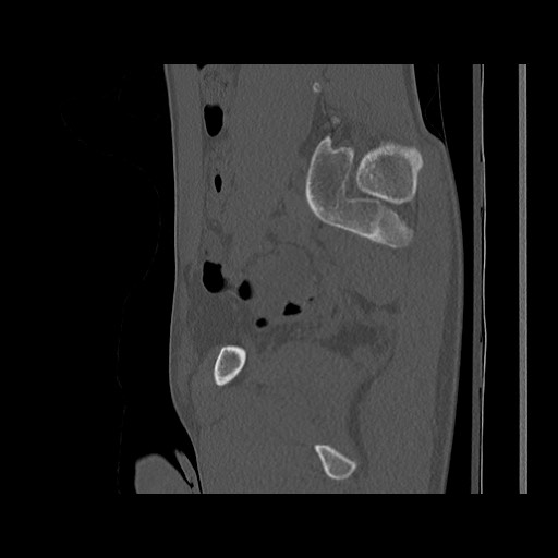 Normal pelvis (Radiopaedia 51473-57238 Sagittal bone window 54).jpg