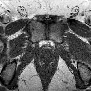 File:Normal prostate (MRI) (Radiopaedia 29986-30535 Axial T1 3).jpg