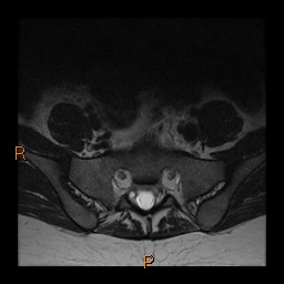 File:Normal spine MRI (Radiopaedia 77323-89408 Axial T2 28).jpg